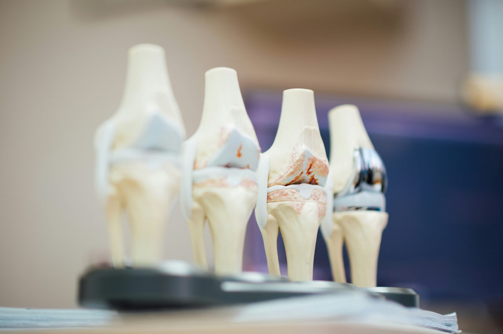 Why is my hip replacement hurting after 5 years and common causes