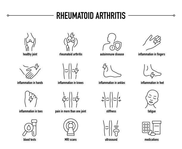 What Are the 4 Stages of Rheumatoid Arthritis and how joint damage may progress over time.