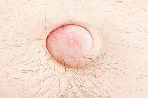 What does a Bartholin cyst look like pictures showing a lump near the vaginal opening